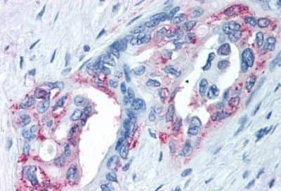 Immunohistochemistry-Paraffin: TRPM8 Antibody [NBP3-14505] - Immunohistochemistry of formalin-fixed, paraffin-embedded human pancreas carcinoma after heat-induced antigen retrieval.